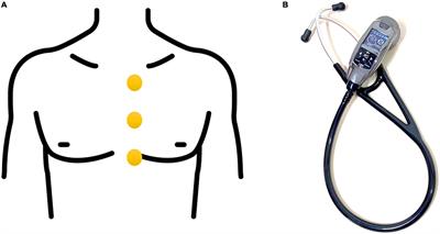 Augmented detection of septal defects using advanced optical coherence tomography network-processed phonocardiogram